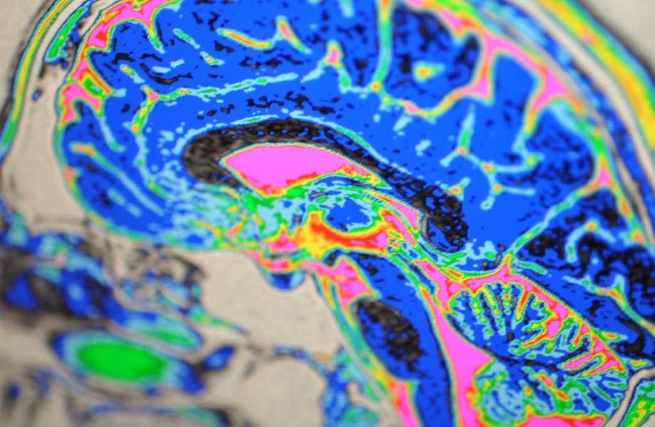 Migräne-ensteht-im-zentralen-Nervensystem-Schmerzklinik-Kiel