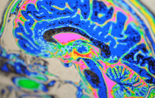 Migräne ensteht durch veränderte Signalübertragung und Störung der Energieversorgung von Nervenzellen im Gehirn